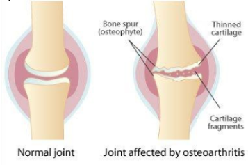 Knee Pain